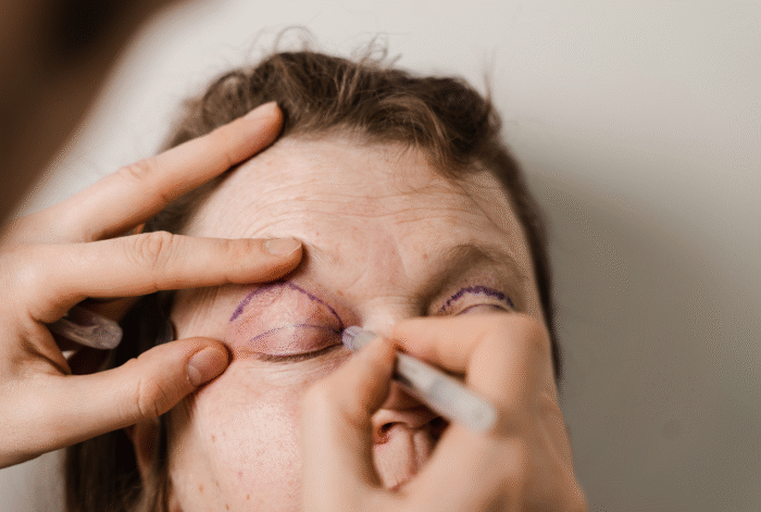 Upper Eyelid Aesthetics (Upper Blepharoplasty)