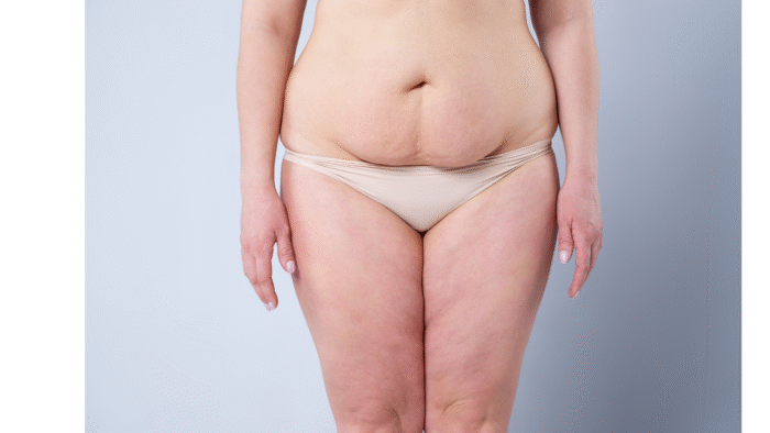 Tummy Tuck (Abdominoplasty)