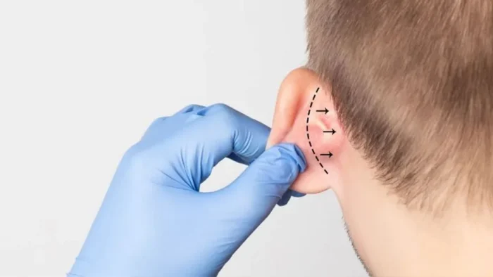 Kepçe Kulak Estetiği (Otoplasti)