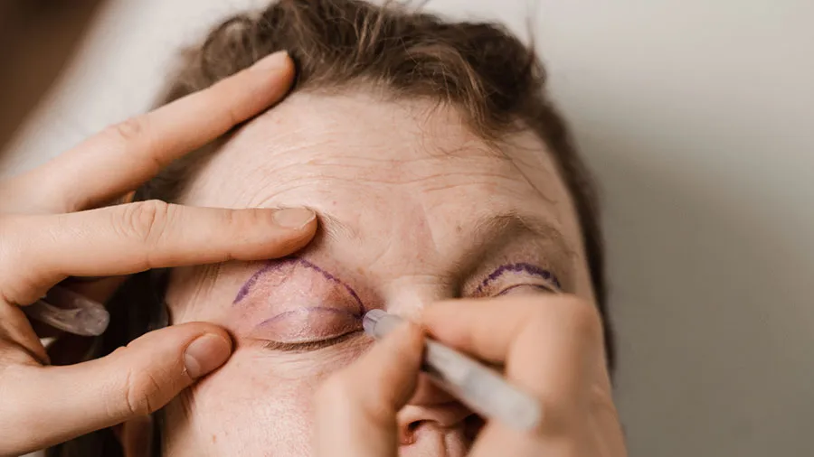 Üst Göz Kapağı Estetiği (Blefaroplasti)