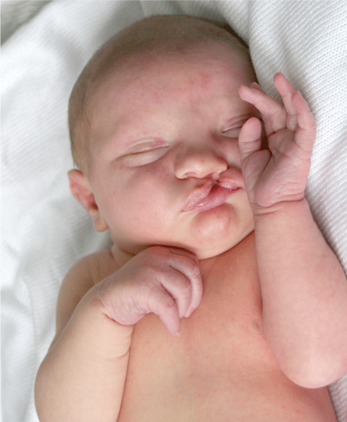 Cleft Lip Repair