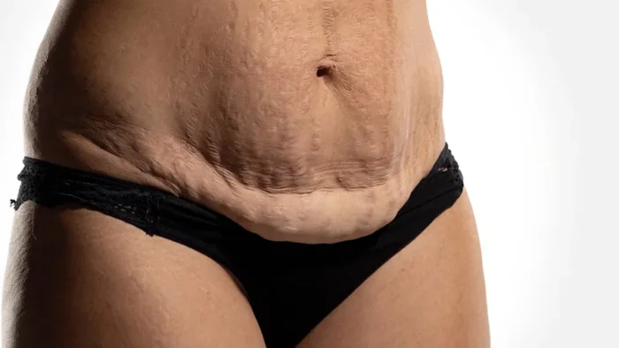 Annelik Estetiği (Mommy Makeover)