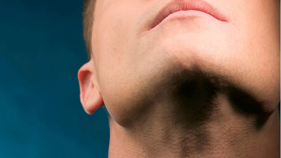 Çene Ucu Estetiği (Mentoplasti)