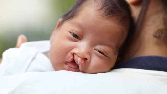 Damak Yarığı Onarımı