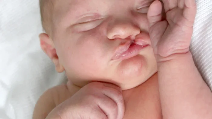 Dudak Yarığı Onarımı