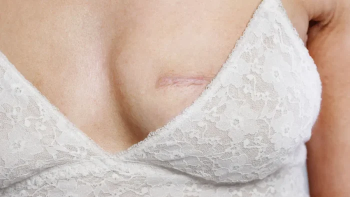 İmplant ile Meme Rekonstrüksiyonu