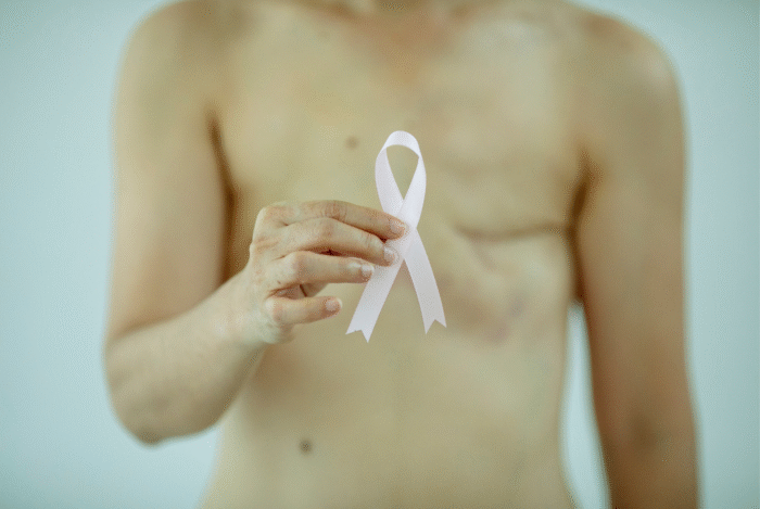 Breast Reconstruction via Implant + Latissimus Dorsi Flap