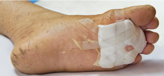 Tissue Transfers – Flap Surgeries