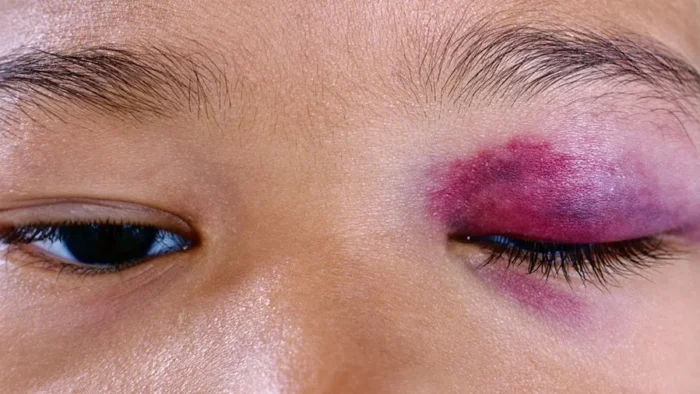 Maksillofasiyal Travma