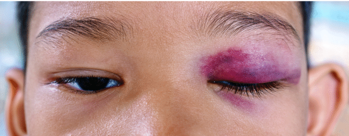 Maxillofacial Trauma