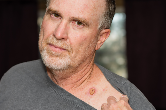 What are Skin and Soft Tissue Cancers ?