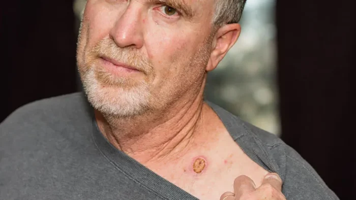 Deri ve Yumuşak Doku Kanserleri