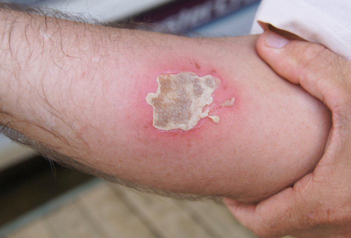Wound and Burn Treatments