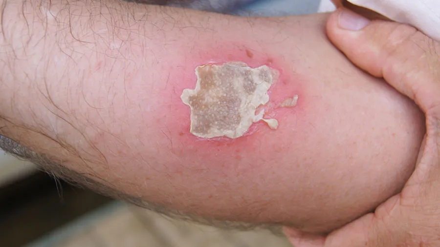 yara ve yanık tedavileri