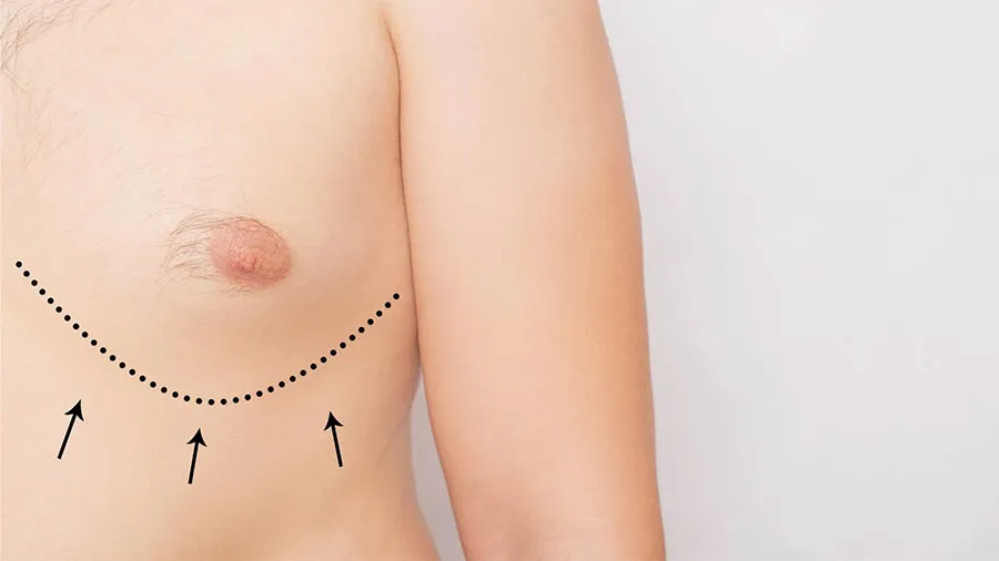 erkeklerde jinekomasti neden olur