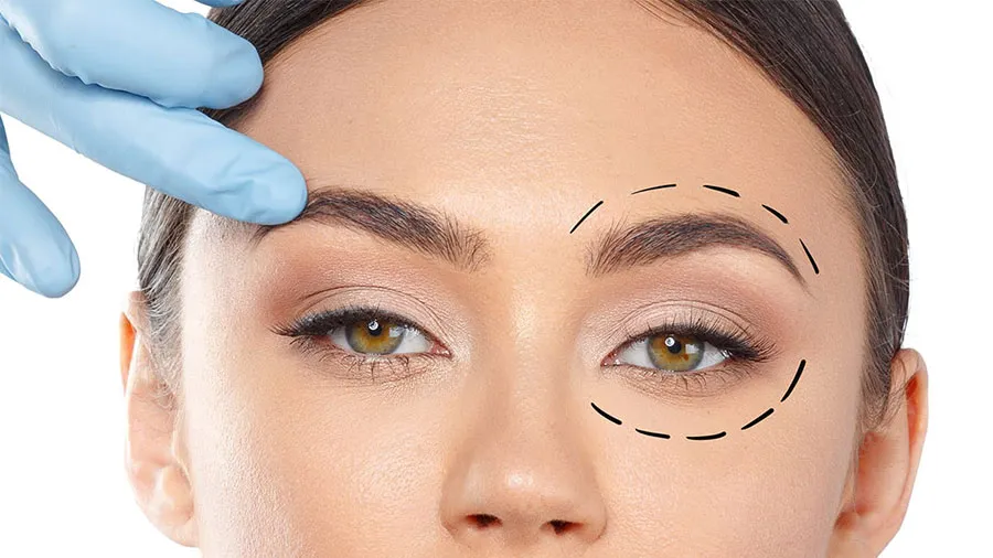 göz kapağı ameliyatı sonrası