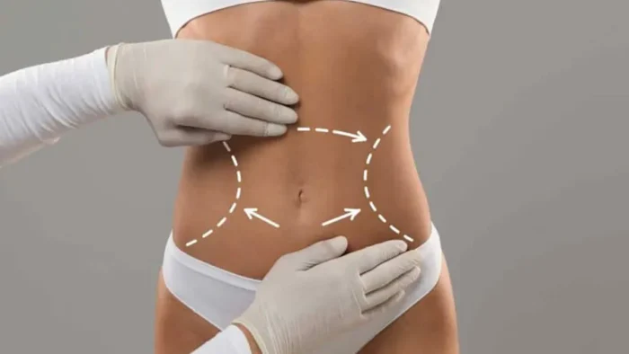 Karın Germe Ameliyatı Sonrası Süreç