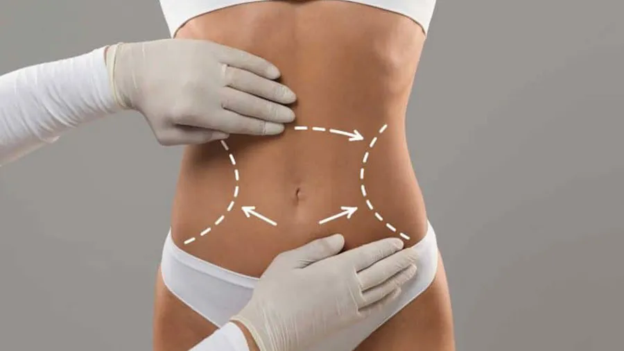 karın germe ameliyatı sonrası süreç