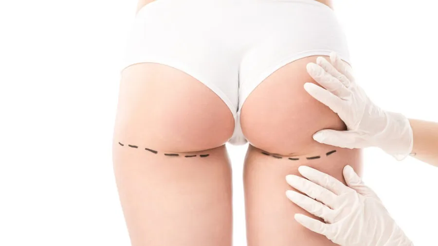 popo estetiğinde implant